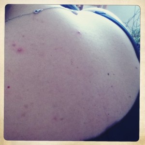 boutons-grossesse-dos-poitrine