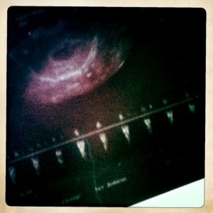 echographie-embryon-SA6-3-5mm