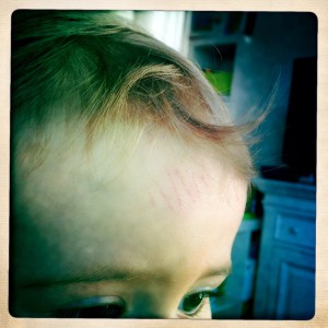 bébé arnidol bosse